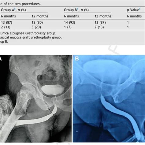 Retrograde Urethrogram Of A Patient A Pre Operative B Months