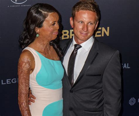 Turia Pitt And Michael Hoskin Love Story In Pictures