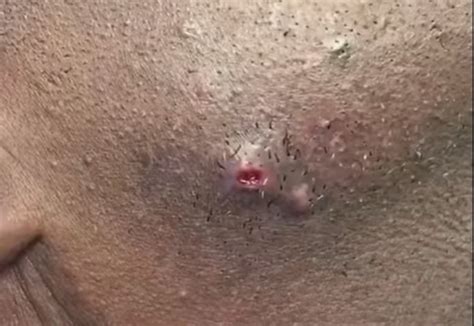 New Pimple Popping Videos Page 34 Of 216 Worst Of The Worst