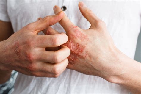 Eczema Definition Causes And Treatment