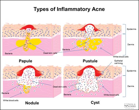 Cystic Acne Diagram Health Medicine And Anatomy Reference Pictures