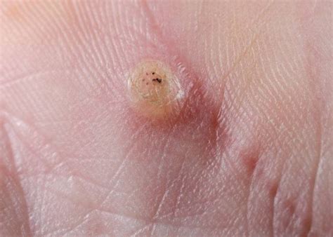 In this article, we look at both home remedies and clinical treatments for getting rid of warts on the fingers. What is a seed wart? How is it treated? - Quora