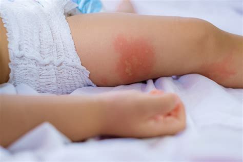 What does a skin allergy look like? Serious allergic reaction? 11 ways of knowing if you're ...