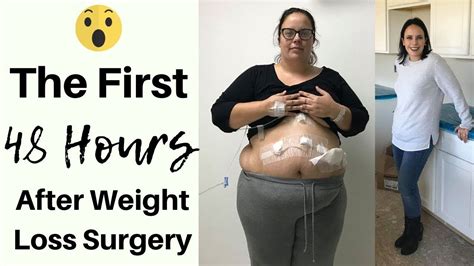 First 48 Hours After Vsg What Happened Gastric Sleeve Surgery Pre