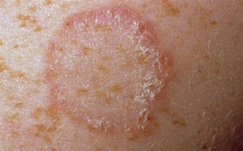Fungal Rash Pictures Symptoms Causes Treatment Prevention Healthmd My