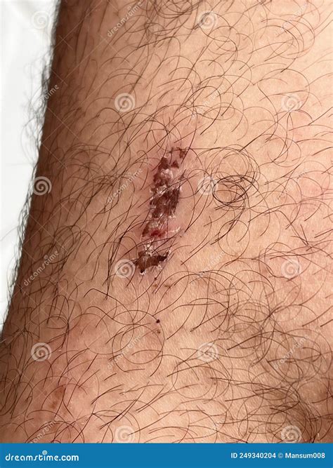 Scar On Skin The Wound Form Scabs On Leg Man With Long Scab Wound On