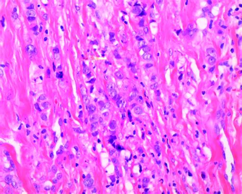 Ectopic Lobular Breast Cancer On The Anterior Chest Wall A Rare Entity