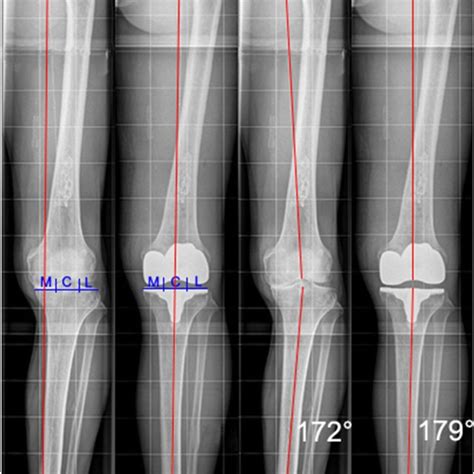 Skyline View Of The Knee Joint Before And After Itotal™ Cr G2