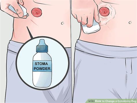 How To Change A Colostomy Bag 12 Steps With Pictures