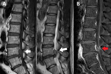 Herniated Disc Thoracic Mri