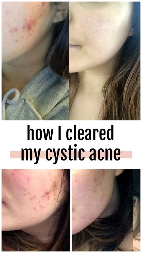 How To Treat Cystic Nodular Acne