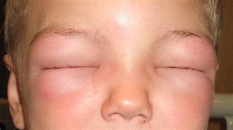 Allergy Medicine For Swollen Face Medicinewalls