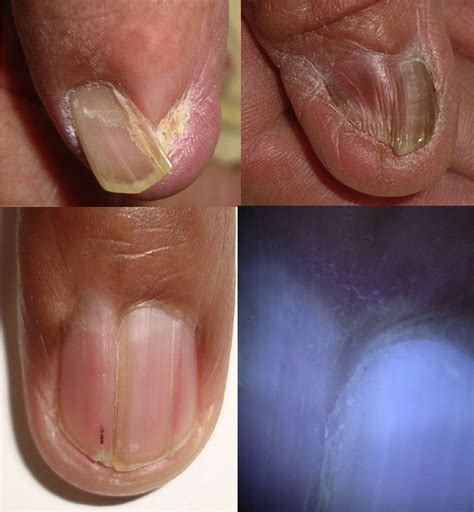 Diagnosis Using The Proximal And Lateral Nail Folds Dermatologic Clinics