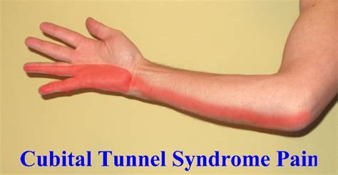 Cubital Tunnel Syndrome Treatment Ulnar Nerve Neuritis Singapore