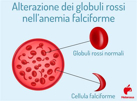 Anemia Falciforme Cosè Cause Sintomi E Trattamento