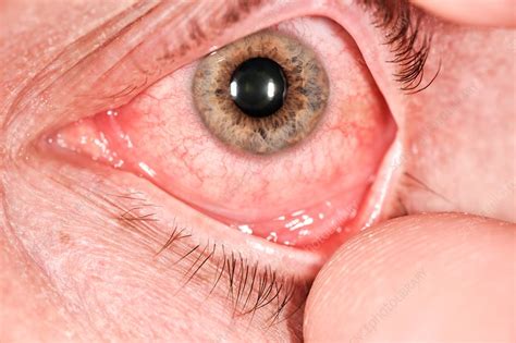 Allergic Conjunctivitis Stock Image C0381687 Science Photo Library
