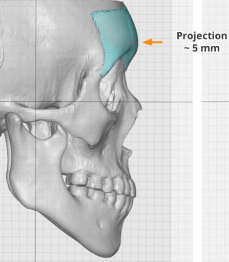 Female Custom Brow Bone Implant Design Side View Dr Barry Eppley