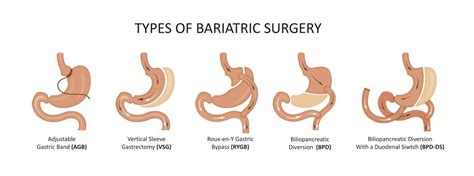 Introduction To Bariatric Surgery Bariatric Clinic Singapore By G