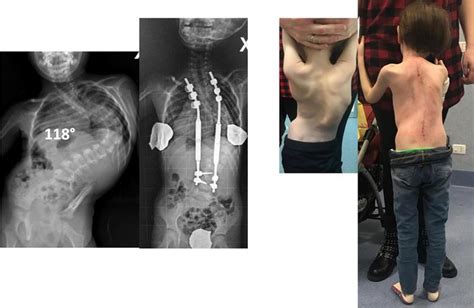 Scoliosis Girl Cured With Magnets In First For Italy English Ansait