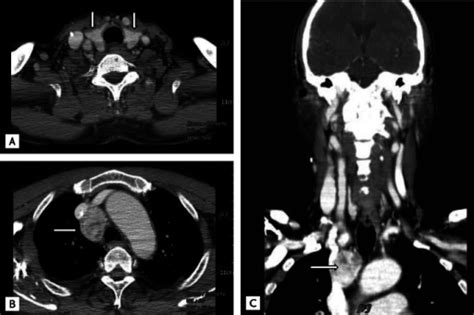 A Normally Located Thyroid Gland Arrows B Heterogenously