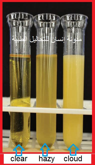 Physical Examination Of Urine Urine Clarity