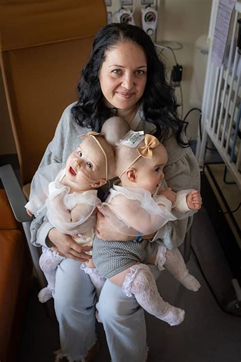 9 Month Old Twins Born Conjoined At The Head Separated