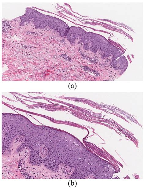 Skin Histopathology A Irregular Psoriasiform Hyperplasia Thickened