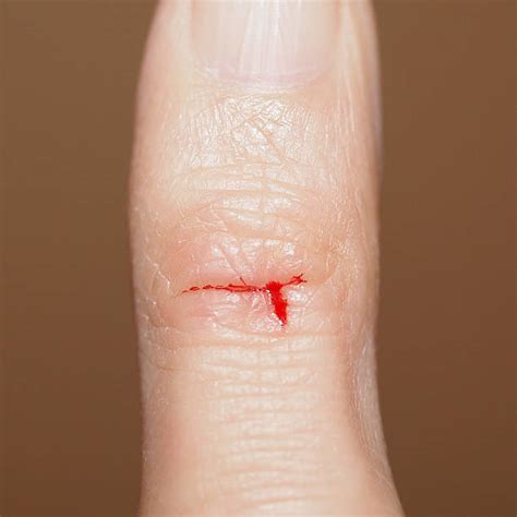 Best Cut Finger Stock Photos Pictures And Royalty Free Images Istock