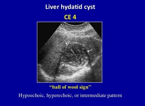 Liver Hydatid Ce 4 Mixed Hypo And Hyperechoic Contents With