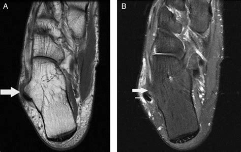 Tenosynovitis Of The Peroneal Tendons Associated With A Hypertrophic