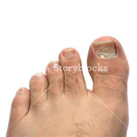 Closeup Of A Hairy Human Foot And Toes With A Cracked And Peeling Toe