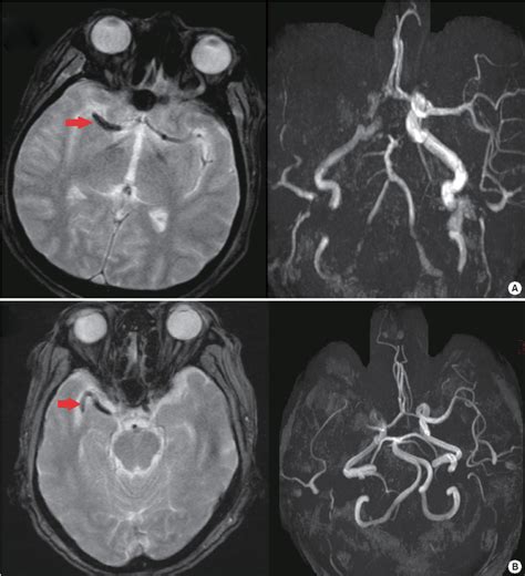 Pdf Magnetic Resonance Imaging In Acute Ischemic Stroke Treatment