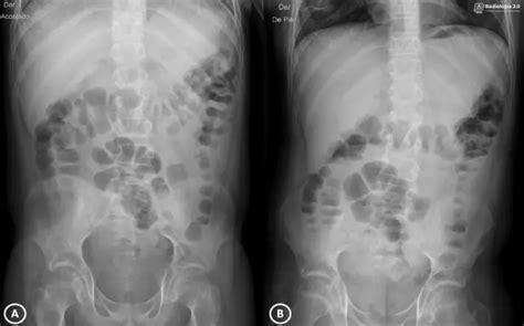 Radiografía De Abdomen Ap Radiología 20