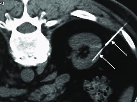 Percutaneous Ct Guided React Injection Patient In Prone Position In Ct