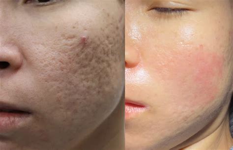 Best Acne Scar Treatment Brisbane Cutis Dermatology