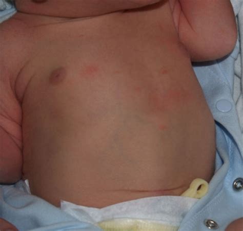 Abdomen Newborn Nursery Stanford Medicine