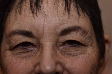 Endoscopic Brow Lift Before And After Patient 05 Morgenstern Center