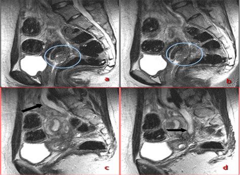 Learn about treatment, causes, stages, surgery, and diagnosis. Centro Italiano Endometriosi Archivi - Endometriosi: Malattia, Prevenzione, Cura