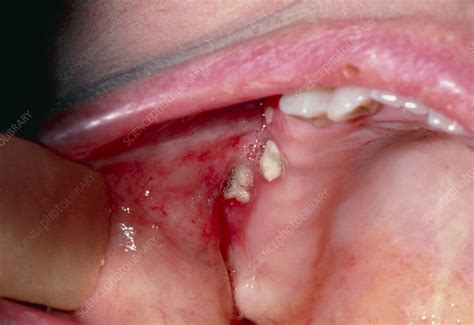 Infection At Previously Treated Gum Cancer Site Stock Image M