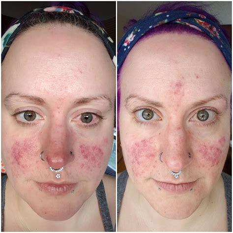 Ivermectin Rosacea Rosacea Before And After Treatment Image Courtesy Dr Ivermectin
