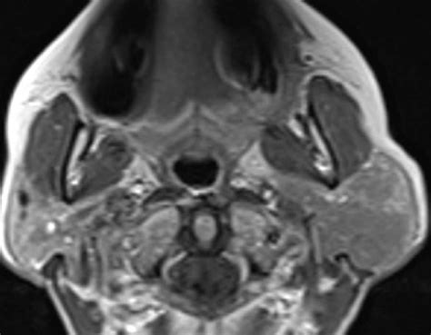 Malt Lymphoma Neuro Mr Case Studies Ctisus Ct Scanning