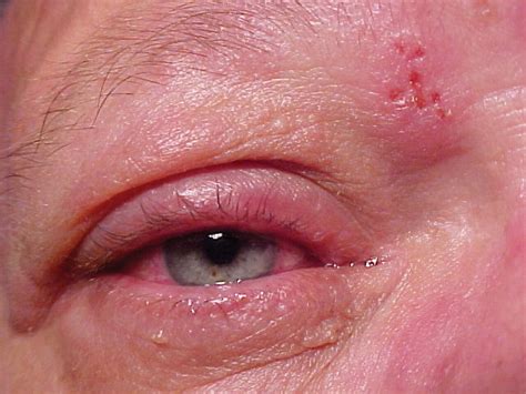 A diagnosis can usually be made based on the symptoms and the appearance of the rash, as well as through an examination of the eye. Pseudodendrites Of Herpes Zoster Ophthalmicus — Herpes Free Me