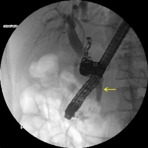 Endoscopic Retrograde Cholangiopancreatography Ercp Sagittal View