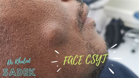 Massive Face Cyst Dr Khaled Sadek Youtube