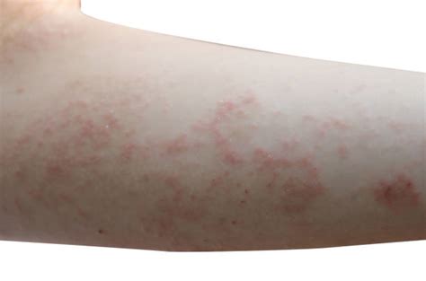 Scabies Stock Photos Pictures And Royalty Free Images Istock