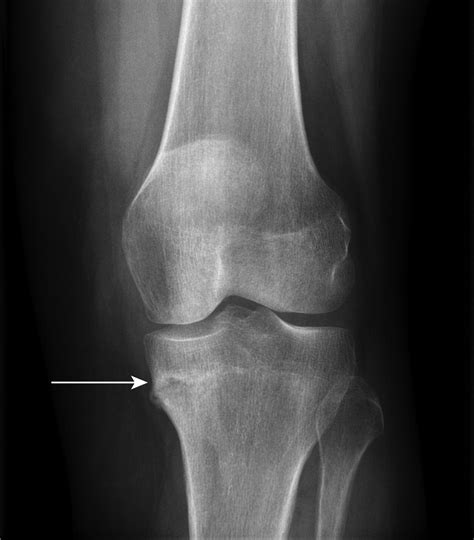 Fractures Of The Proximal Tibia Associated With Longterm Use Of