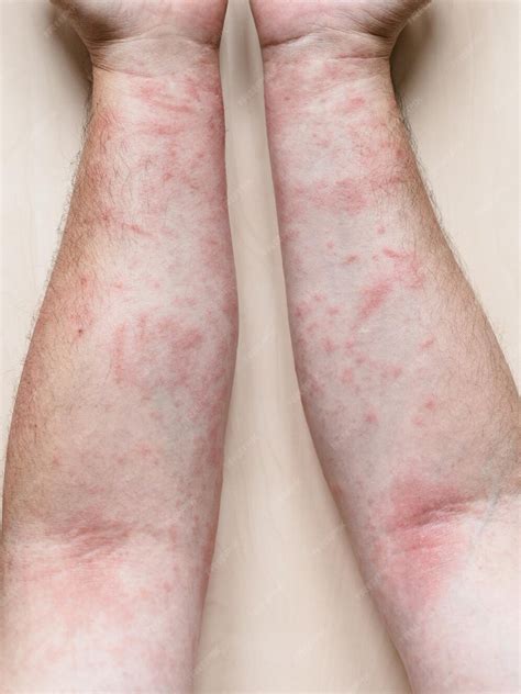 Premium Photo Male Arms With Itchy Red Rash