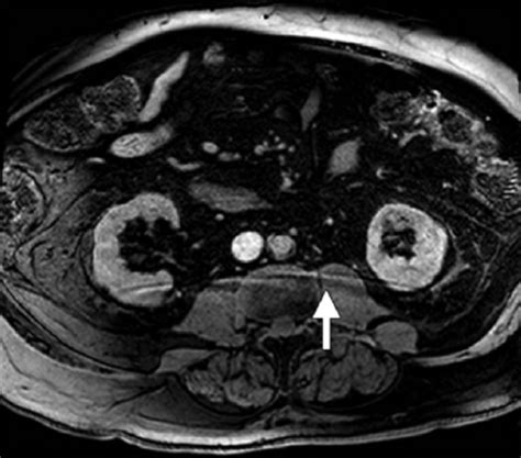 Axial Contrast Enhanced Mr Image Obtained In The Portal Venous Phase
