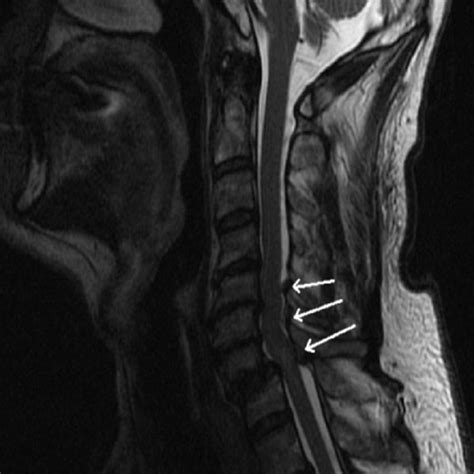Anterior Posterior Radiograph Of The Cervical Spine Shows The Treatment