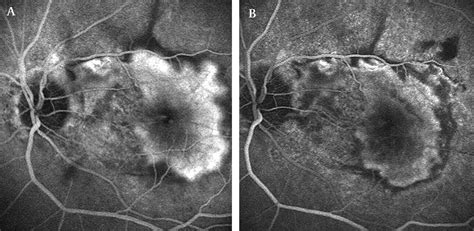 Low Fluence Rate Photodynamic Therapy Combined With Intravitreal